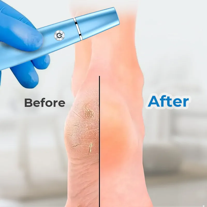 Hot Sale - 50% OFFElectric Feet Callus Remover